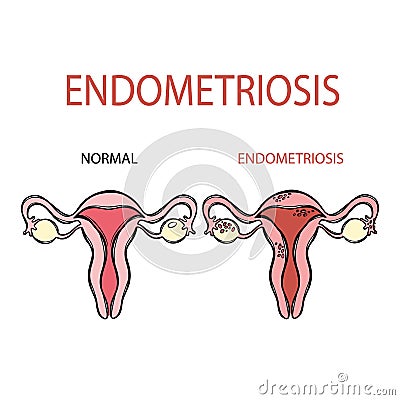 ENDOMETRIOSIS NORMAL FEMALE Reproductive System Education Stock Photo