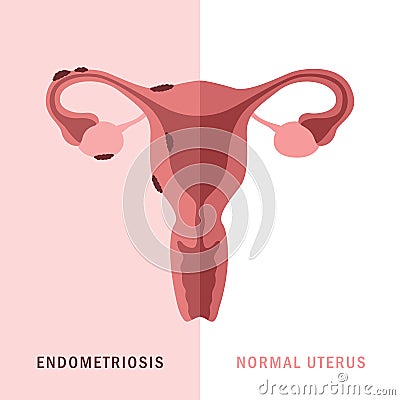 endometriosis and normal uterus womens health anatomy info graphic Vector Illustration