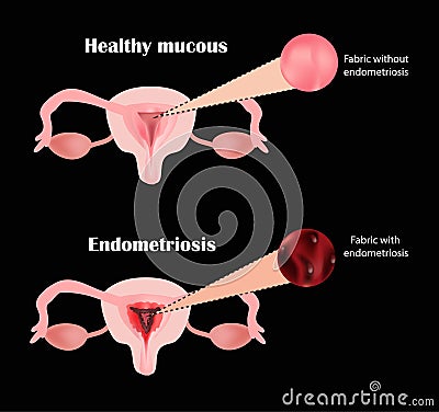 Endometriosis. The structure of the pelvic organs. Adenomyosis. The endometrium. Vector illustration Vector Illustration
