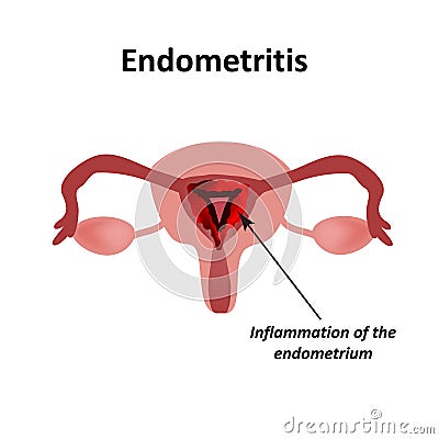 Endometritis. Inflammation of the endometrium. Inflammation of the uterus. Infographics Vector illustration on Vector Illustration