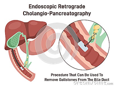 Endoscopic retrograde cholangiopancreatography. ERCP, bile duct diagnosis. Vector Illustration