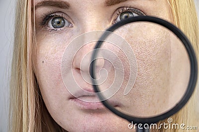 Enlarged pores, black spots, acne, rosacea close-up on the cheek. A woman is being examined by a doctor. Dermatologist examines Stock Photo