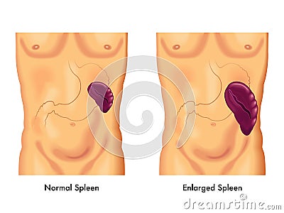 Enlarged spleen Vector Illustration