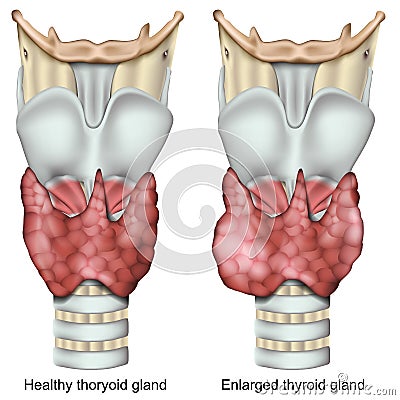 Enlarged thyroid gland 3d medical illustration isolated on white background Cartoon Illustration
