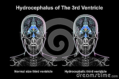 Enlargement of the third brain ventricle, 3D illustration Cartoon Illustration