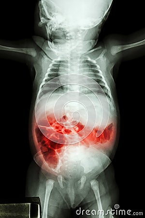 Enteritis (X-ray of sick infant and inflammation of intestine) Stock Photo