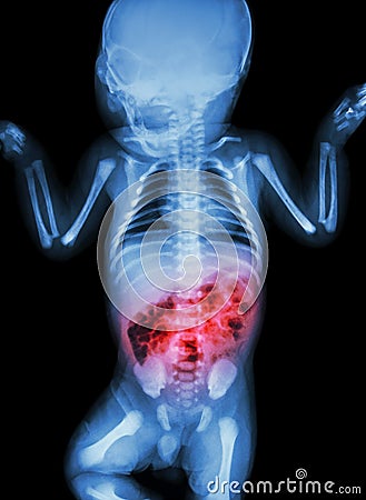 Enteritis (X-ray of sick infant and inflammation of intestine) Stock Photo