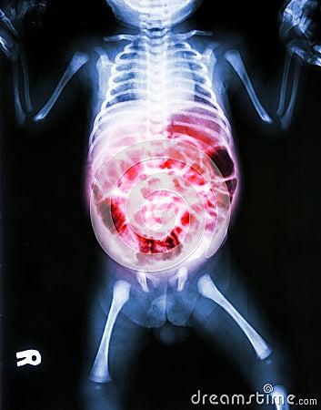 Enteritis (X-ray of sick infant and inflammation of intestine) Stock Photo