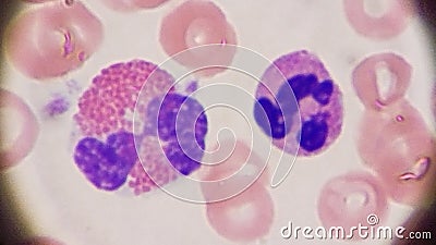 Eosinophil and neutrophil seen on peripheral blood smear Stock Photo