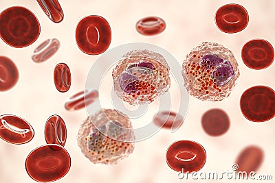 Eosinophilia, blood smear showing multiple eosinophils surround by red blood cells Cartoon Illustration