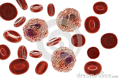 Eosinophilia, blood smear showing multiple eosinophils surround by red blood cells Cartoon Illustration