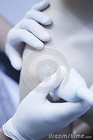 EPI percutaneous intratissue electrolysis Stock Photo