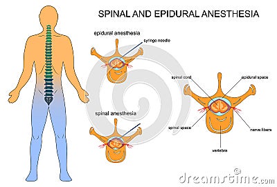 Epidural and spinal anaesthesia Vector Illustration