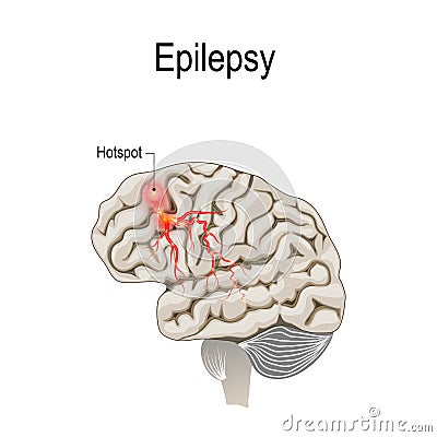 Human brain with hotspot hotspot of epilepsy Vector Illustration