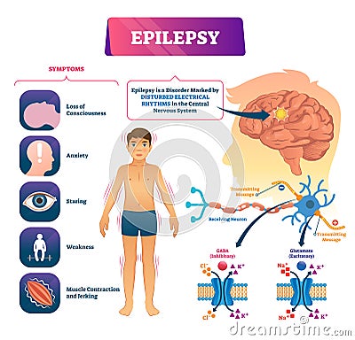 Epilepsy vector illustration. Labeled sick CNS disorder educational scheme. Vector Illustration