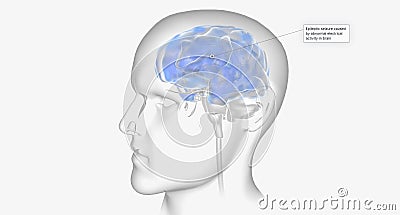 Epileptic seizure caused by abnormal electrical activity in brain Stock Photo