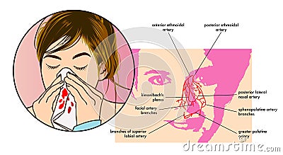 Epistaxis Symptoms Vector Illustration