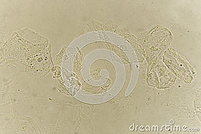 Epithelial cells with bacteria in patient urine Stock Photo