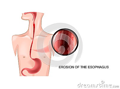 Erosion of the esophagus Vector Illustration