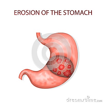 Erosion of the stomach Vector Illustration