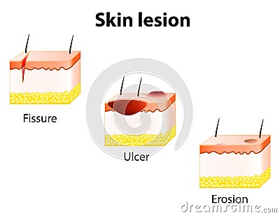 Erosion, Ulcer and Fissure Vector Illustration