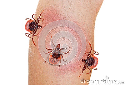 Tick on human leg. Dangerous parasite on human skin. Stock Photo