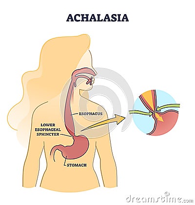 Esophageal achalasia disease with lower sphincter failure outline diagram Vector Illustration