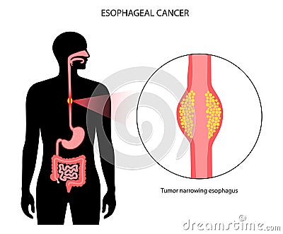 esophageal cancer concept Vector Illustration