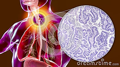 Esophageal cancer, illustration and micrograph Cartoon Illustration