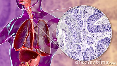 Esophageal cancer, illustration and micrograph Cartoon Illustration