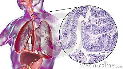 Esophageal cancer, illustration and micrograph Cartoon Illustration