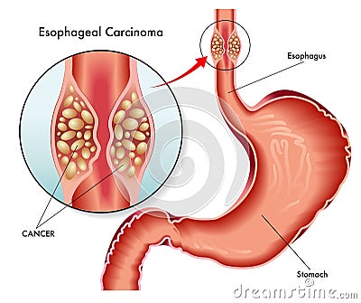 Esophageal carcinoma Vector Illustration
