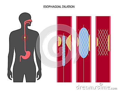 Esophageal dilation procedure Vector Illustration