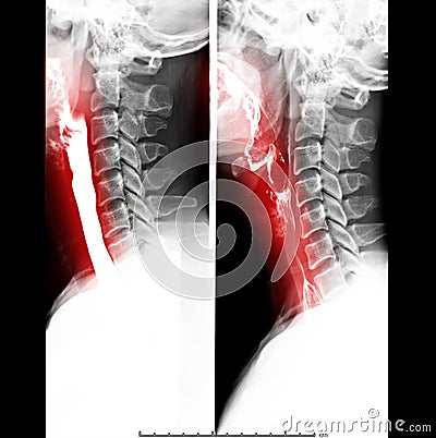 Esophagram or Barium swallow Lateral view . Stock Photo