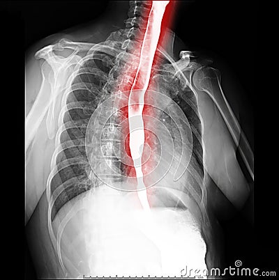 Esophagram or Barium swallow oblique view showing esophagus for diagnosis GERD. Stock Photo