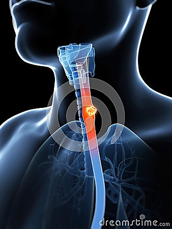 Esophagus cancer Cartoon Illustration