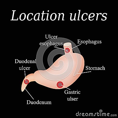 Esophagus ulcer affected. Ulcer of esophagus. Stomach ulcer affected. Gastric ulcer. Duodenum ulcer affected. Vector Vector Illustration