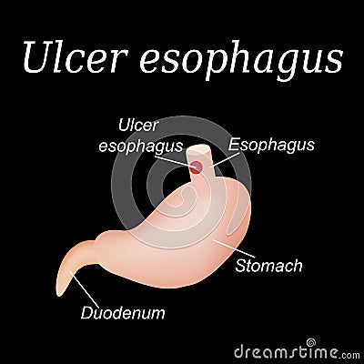 Esophagus ulcer affected. Ulcer of esophagus. Vector illustration on a black background Vector Illustration