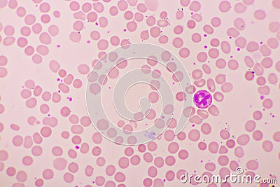 Essential thrombocytosis blood smear with neutrophil cell Stock Photo