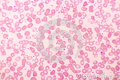 Essential thrombocytosis blood smear Stock Photo