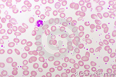 Essential thrombocytosis blood smear Stock Photo