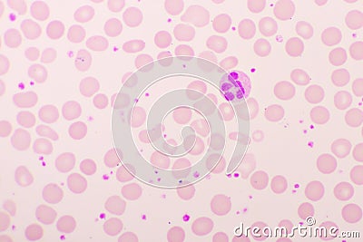 Essential thrombocytosis blood smear Stock Photo