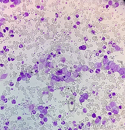 Hematological slide under microscopy showing Essential thrombocytosis, abnormal high volume of platelet and White Blood Cell Stock Photo