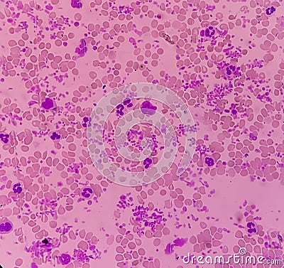 Essential thrombocytosis blood smear showing abnormal high volume of platelet and White Blood Cells. Panmyelosis. Stock Photo