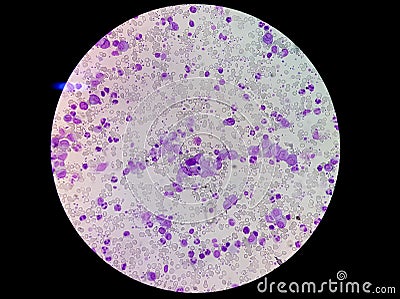 Essential thrombocytosis under microscopy, abnormal high volume of platelet and WBC Stock Photo