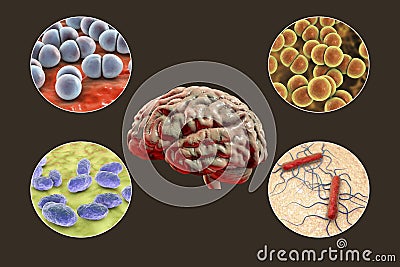 Etiology of bacterial meningitis Cartoon Illustration