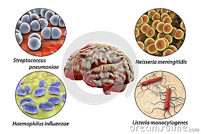 Etiology of bacterial meningitis Cartoon Illustration