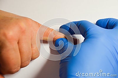 Examination by a dermatologist doctor papilloma warts on the patient`s hand and the doctor`s hand in a blue glove Stock Photo