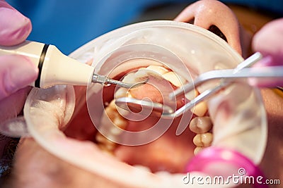 Examination of patient with tartar in clinic with innovative technologies Stock Photo