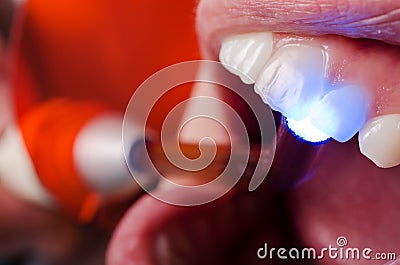 Examination of teeth vitality with UV lamp Stock Photo